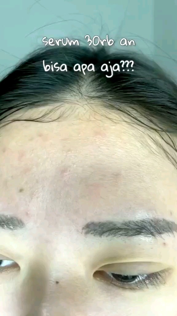 The Originote Acne B5 Serum Jerawat
