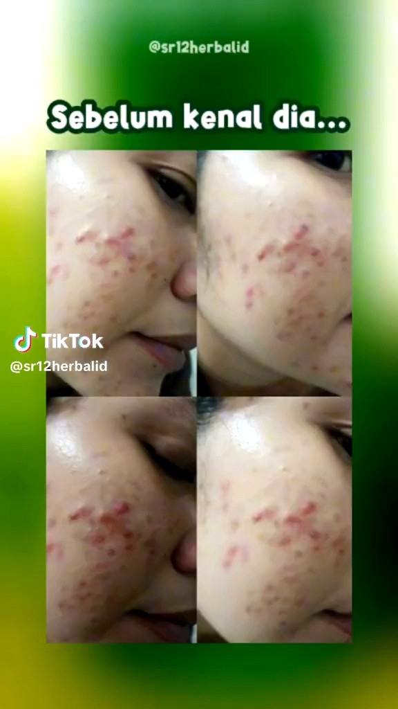 Penghilang Jerawat Facial Wash Green Tea SR12 Skincare Sabun Cair Wajah Kusam
