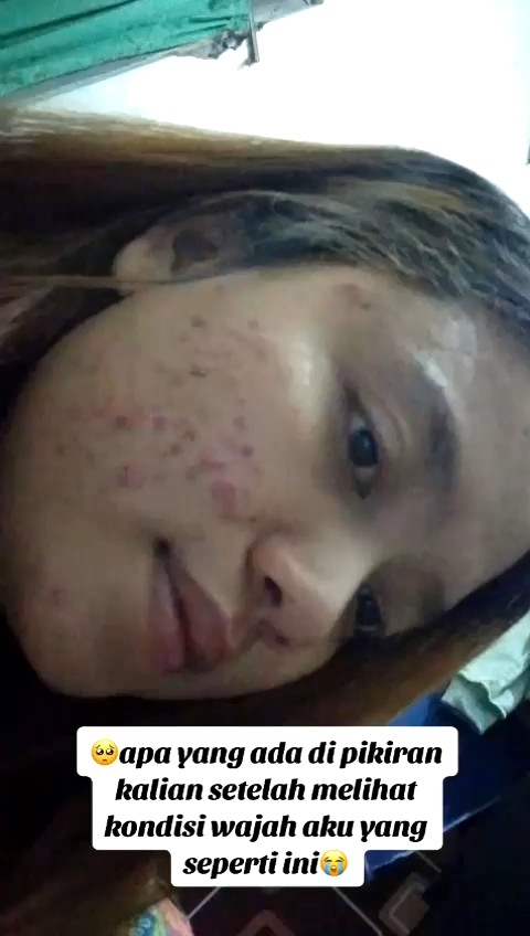 Orlin Beauty Skincare Paket Acne Glowing Platinum Membantu Mencerahkan Wajah Kulit Sensitif  Bekas Berjerawat Flek Hitam Skincare Bpom